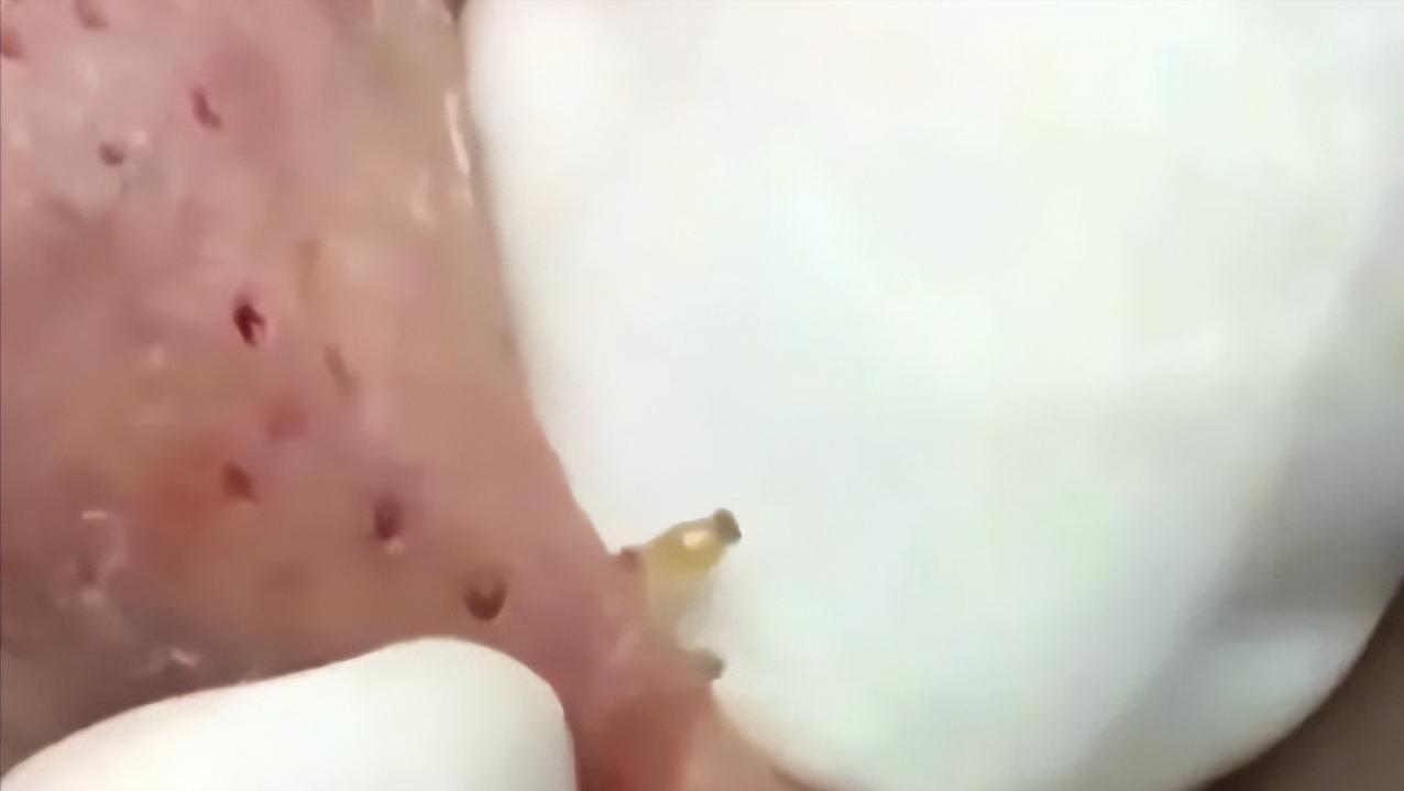 鼻子上有白白的小点可以挤吗,鼻子上黑黑的小点点怎么去除