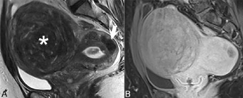 女性盆腔良性病变MR诊断要点