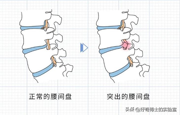 哪些姿势会把腰弄坏,什么姿势容易损伤腰