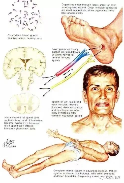 破伤风什么症状,关于破伤风的专业知识