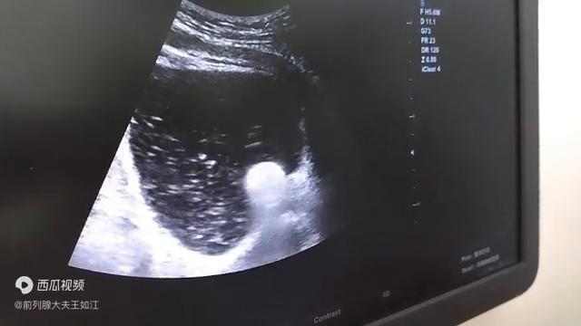 孔医生治疗前列腺炎,经尿道前列腺消融治疗步骤