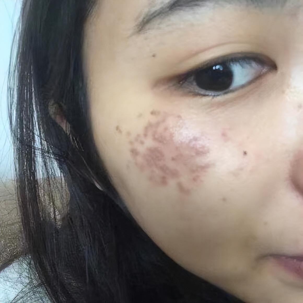 生孩子斑变多了会消失吗,生宝宝皮肤为什么长斑