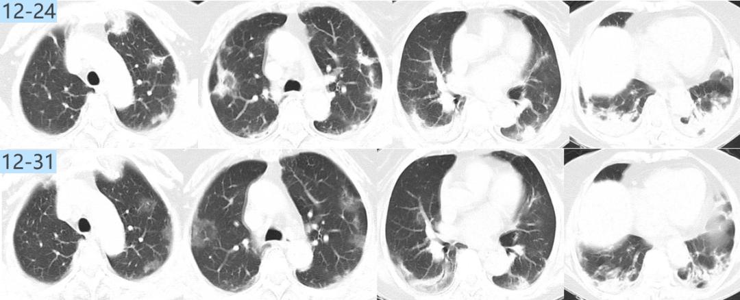 如何解读mNGS阴性结果？何时可能出现假阴性？真阴性又是为何？