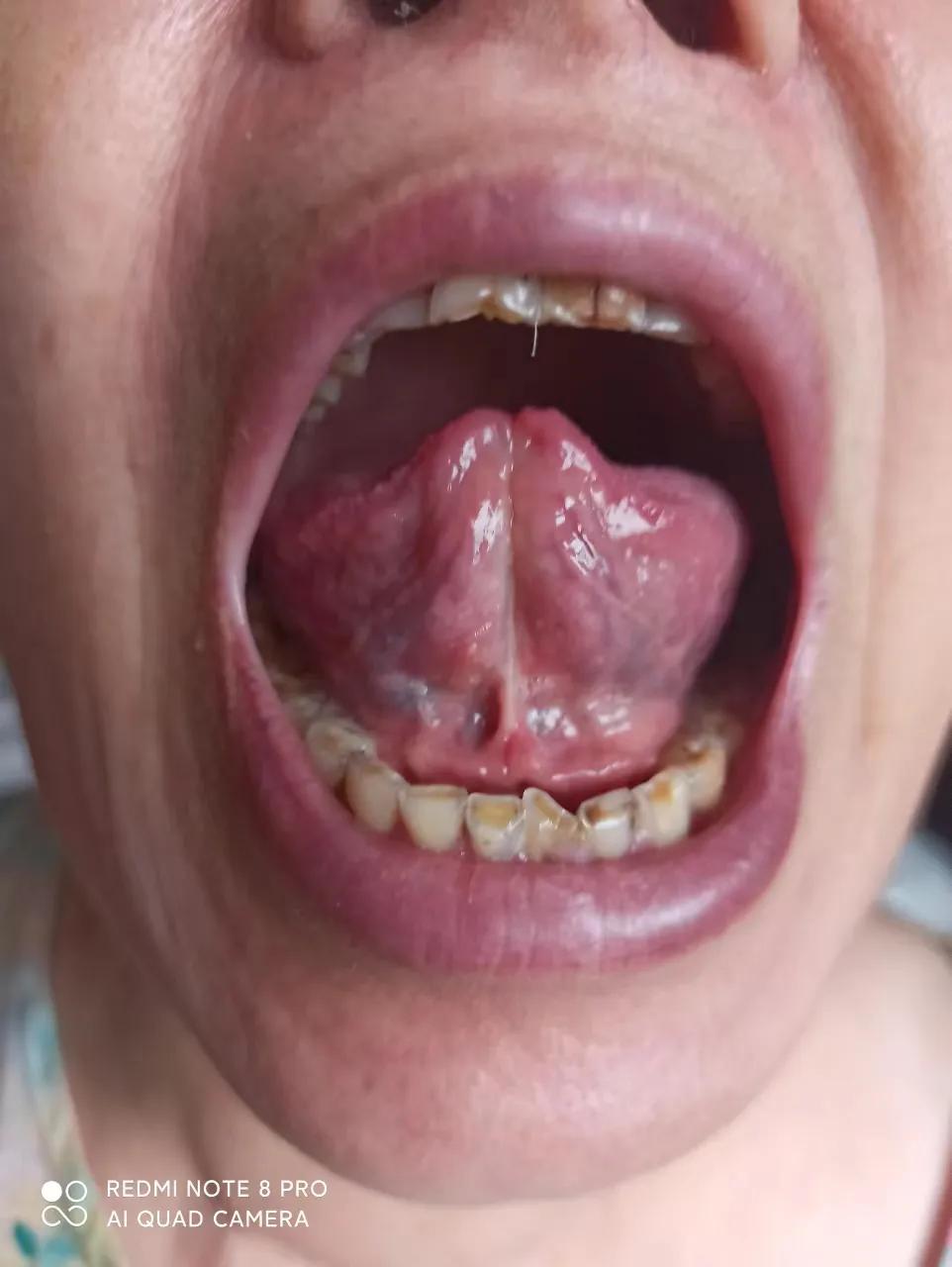 口服中药3个月，确诊5年的干燥综合征患者病情明显缓解