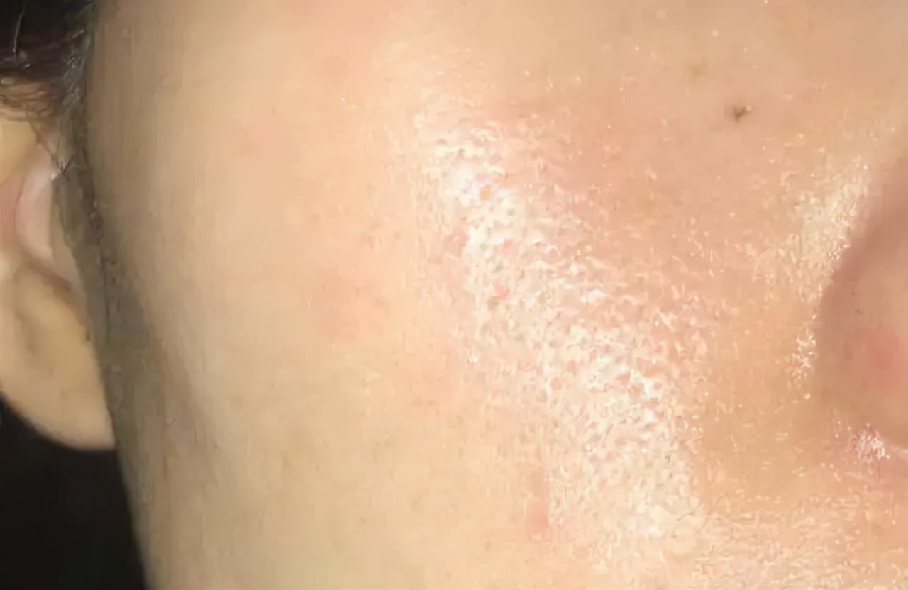 皮肤出油爱长痘怎么解决,皮肤出油长痘暗沉毛孔粗大有粉刺