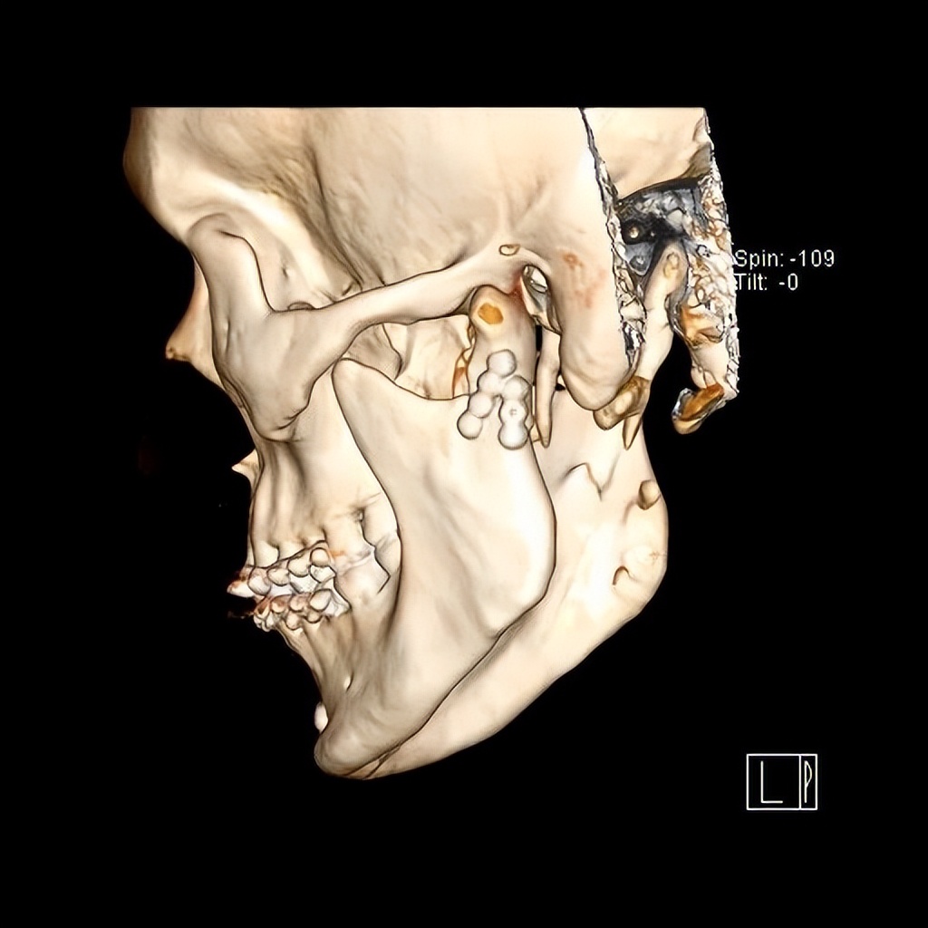 “下巴”外伤莫大意，警惕花式髁突骨折