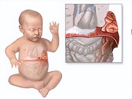 肠梗阻的治疗方法，单腔造瘘术的优缺点，不同造瘘术的适应效果