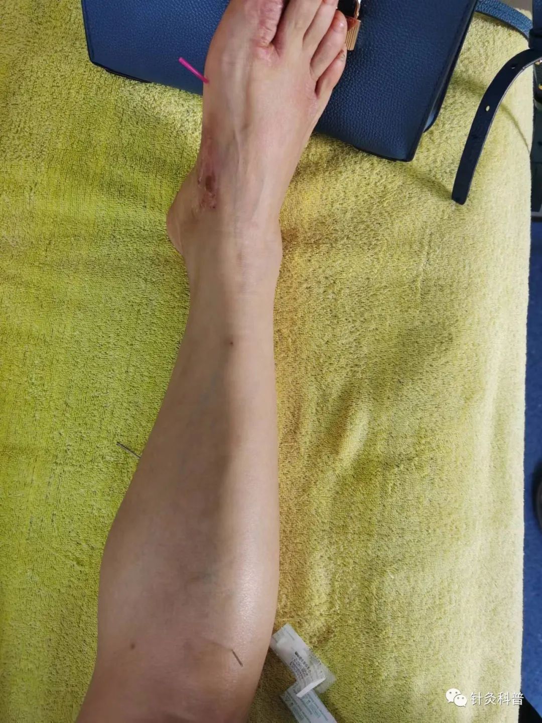 皮肤湿疹可以针灸治疗吗,针灸治疗脸上湿疹的绝招