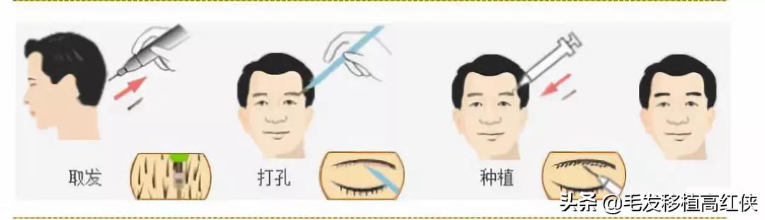 半永久植眉和永久植眉有啥区别,植眉是怎么植的