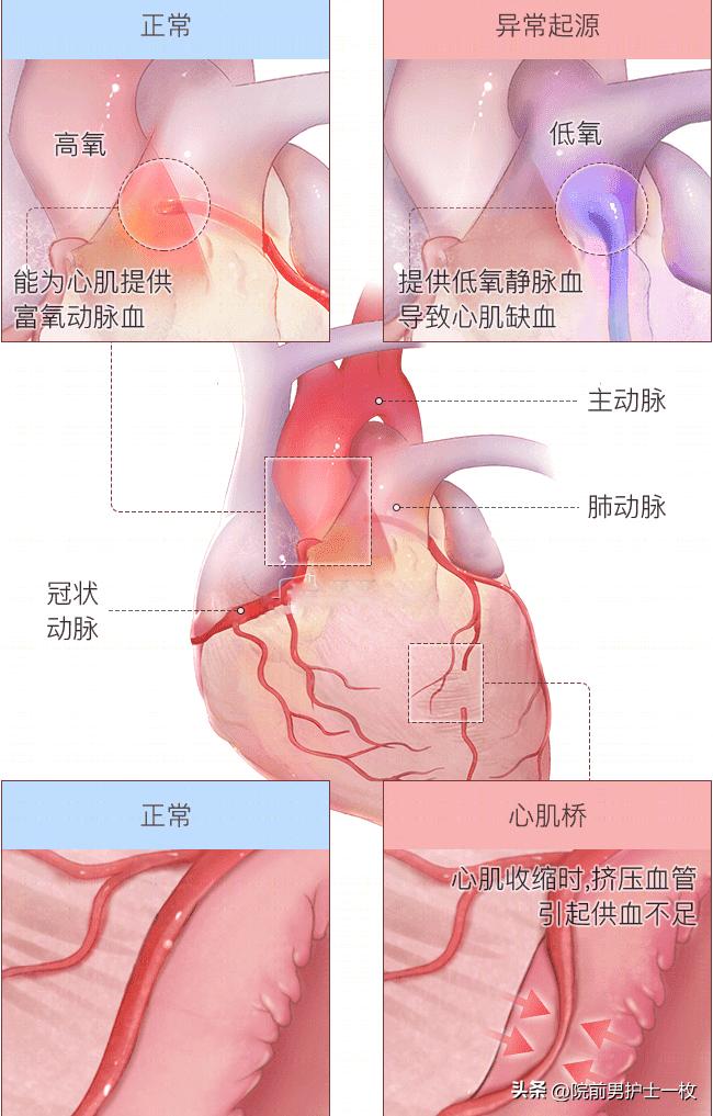 关于心绞痛护理措施的图片,冠心病心绞痛救治成功率