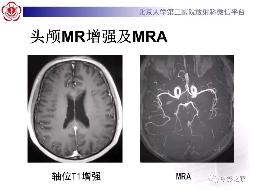 什么叫原发性胼胝体变性,原发性胼胝体变性治疗多少钱