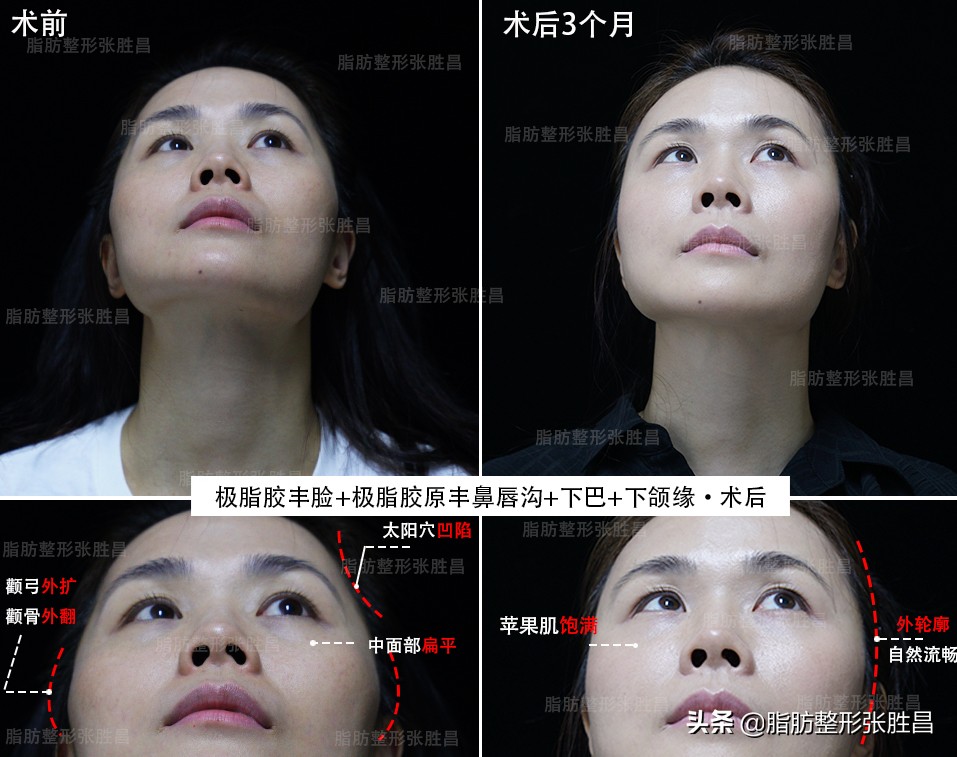 菱形脸颧骨突出怎么改善,颧骨高太阳穴凹陷全脸填充的效果