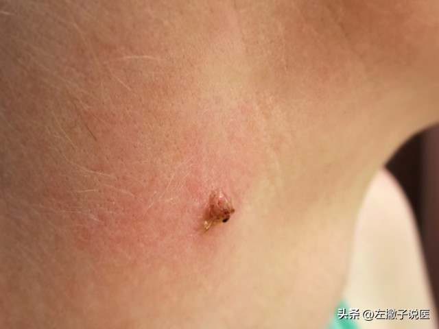 脖子上的“小肉球”是怎么一回事？可以用手抠掉吗？告诉你答案