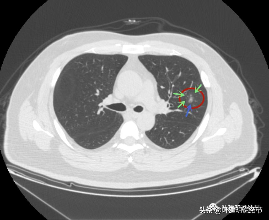 如何判断肺磨玻璃结节是高危结节,肺上有混合磨玻璃结节要注意什么