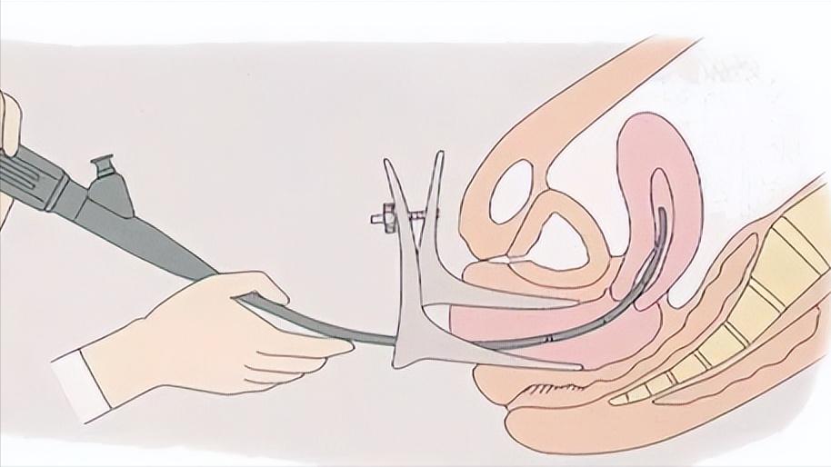 单身女子提醒:女性做妇科体检前，一定要禁欲，否则会非常尴尬