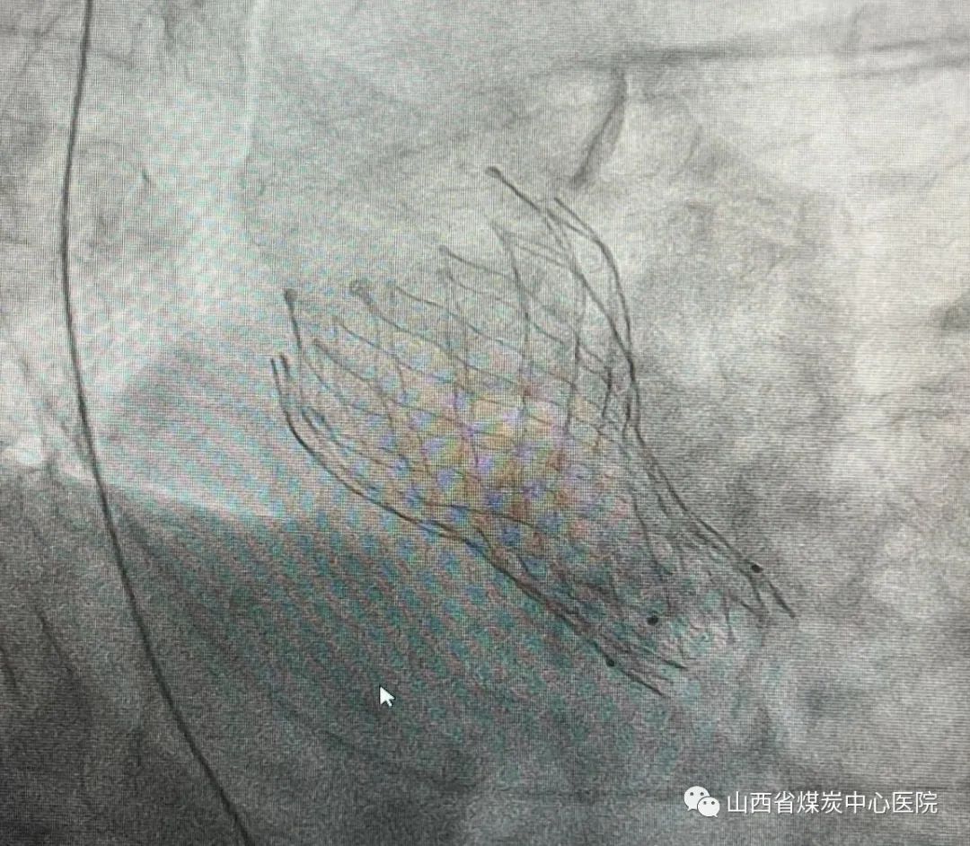 山西煤炭医院心脏中心怎么样,山西省心血管病医院心脏移植成功