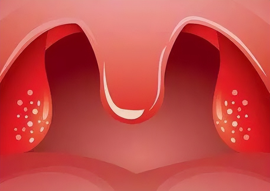 孩子扁桃体发炎引起声音嘶哑,孩子扁桃体发炎嗓子痒老咳怎么办