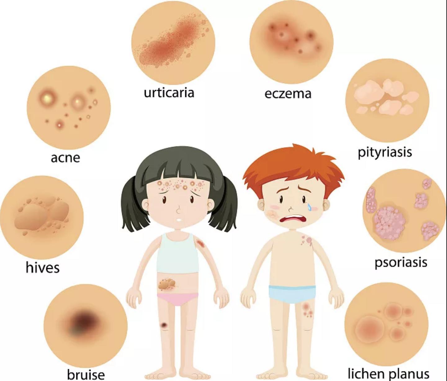 湿疹反复发作如何除根应做何检查,2个月宝宝湿疹反复发作如何除根