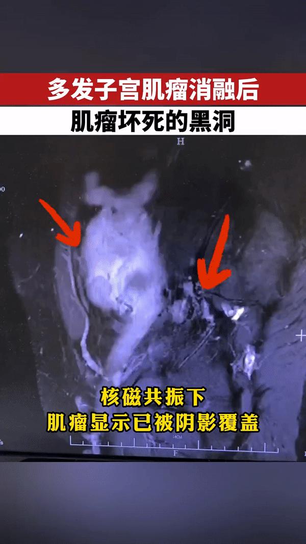 射频消融手术治疗子宫肌瘤效果,子宫肌瘤肌壁间用消融还是海扶刀