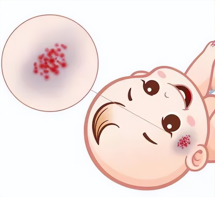 新生儿有胎记怎么办,新生儿有胎记是怎么造成的