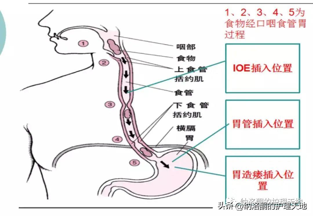 患者呛咳不愿意留置胃管进食，怎么办？