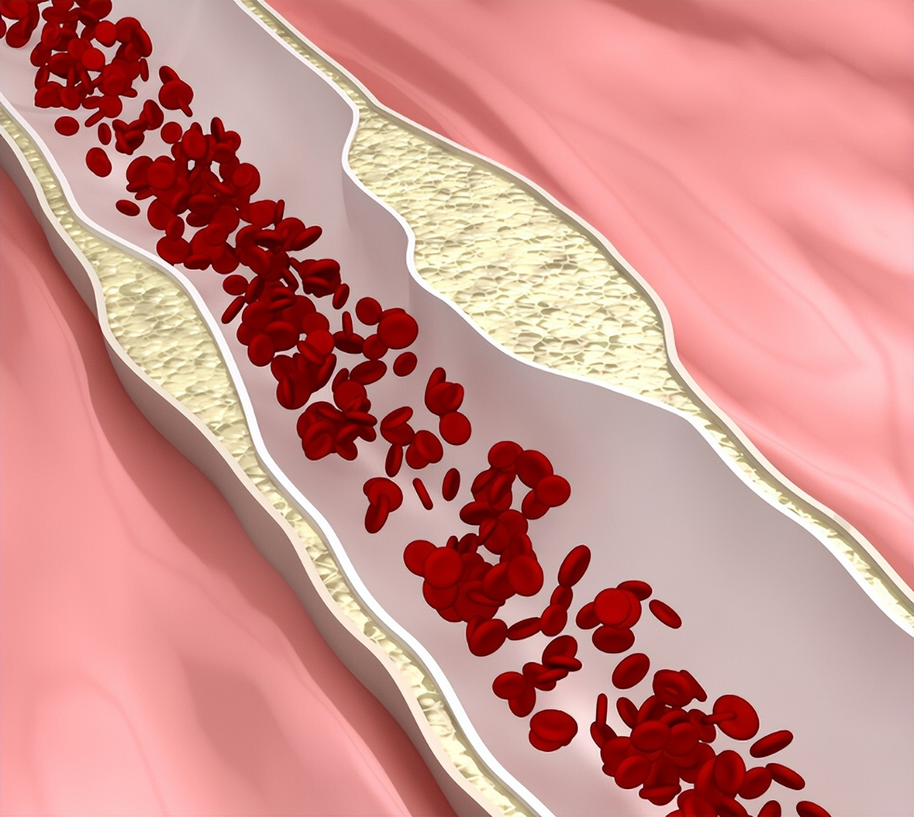 丹参片可以治疗冠心病吗,冠心病能长期吃丹参片吗