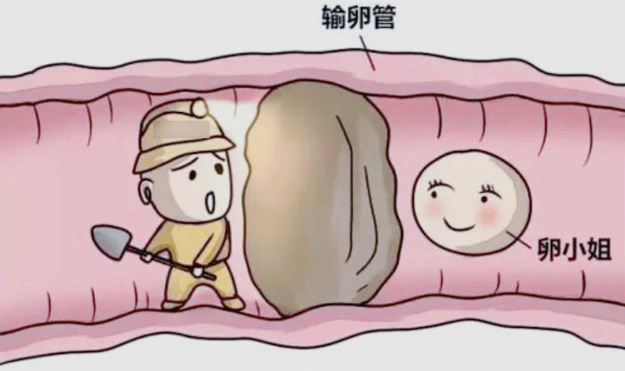 怎么判断输卵管堵塞是结核造成的,检查输卵管堵塞费用大概多少钱