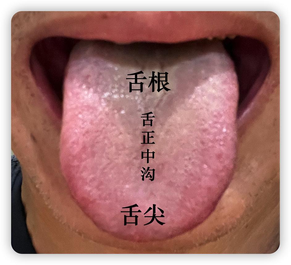 全息舌诊舌形分几种,舌诊八种舌象及解释