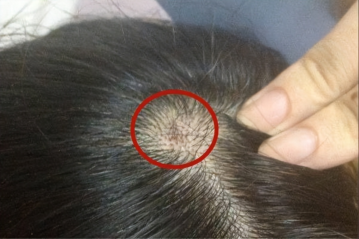 头皮总是长疙瘩或脓包是什么原因,头皮和脸上起疙瘩有脓包怎么回事