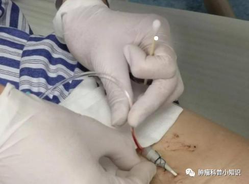 肝癌中晚期介入治疗肝癌最佳时间,肝癌介入科普宣教视频