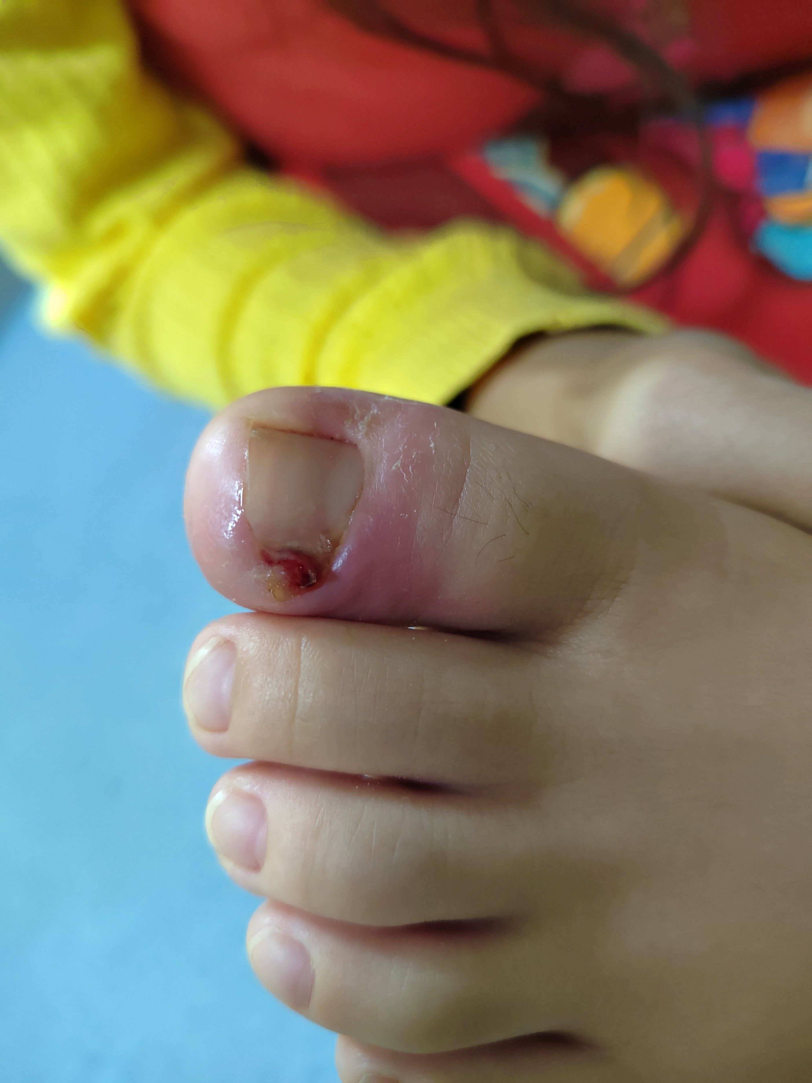 宝宝手指肿胀疼痛是怎么回事,小孩指头红肿疼痛是怎么了