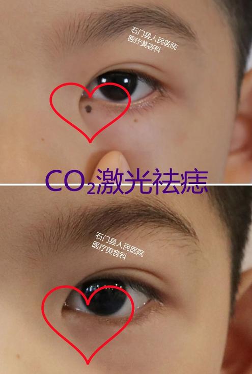 哪些痣应该点哪些痣不应该点,痣多适合什么点痣方法