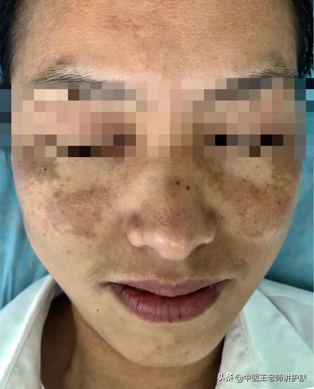 疏肝解郁化瘀最快的好方法,疏肝解郁活血化瘀面色萎黄