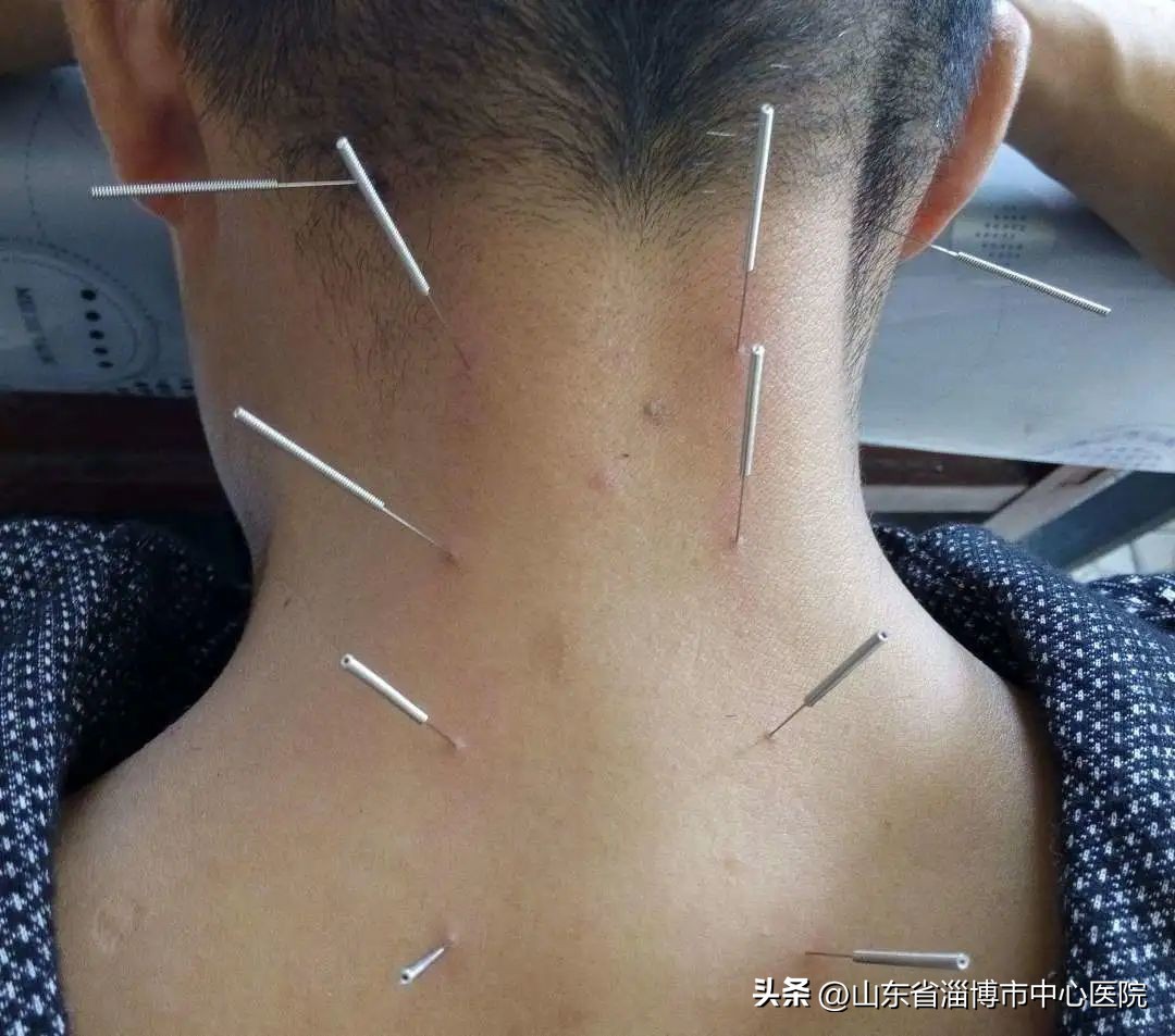 颈部一根筋痛怎么治疗,颈部僵硬紧绷吃什么中药