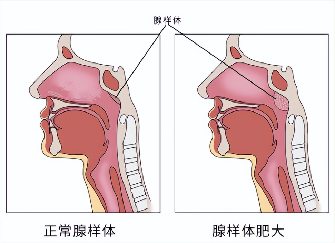 腺样体肥大孩子变丑,腺样体肥大大概几岁开始面貌变丑