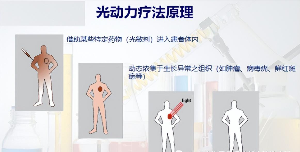 尿道口尖锐性湿疣做激光可以吗,尿道尖锐性湿疣激光后口服药物