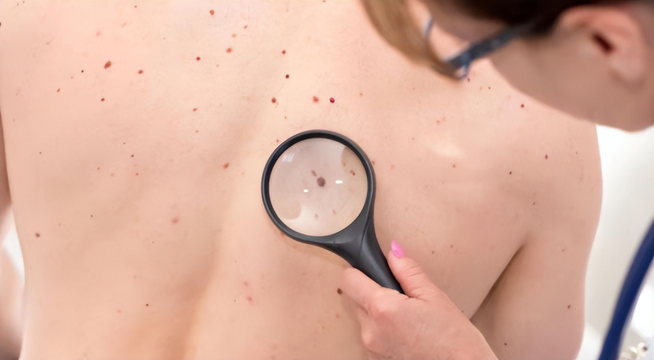 哪些痣有癌变的征兆,哪些痣可能有问题癌变信号别忽视