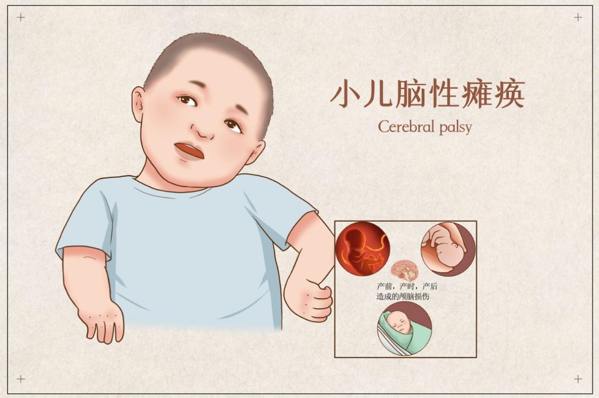 孩子脑瘫家长怎么办,脑瘫儿求医之路