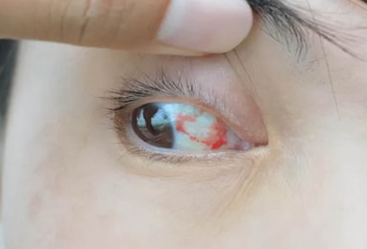 肾衰高血压引起的眼睛模糊怎么治,高血压肾衰竭会引起眼部看不见吗