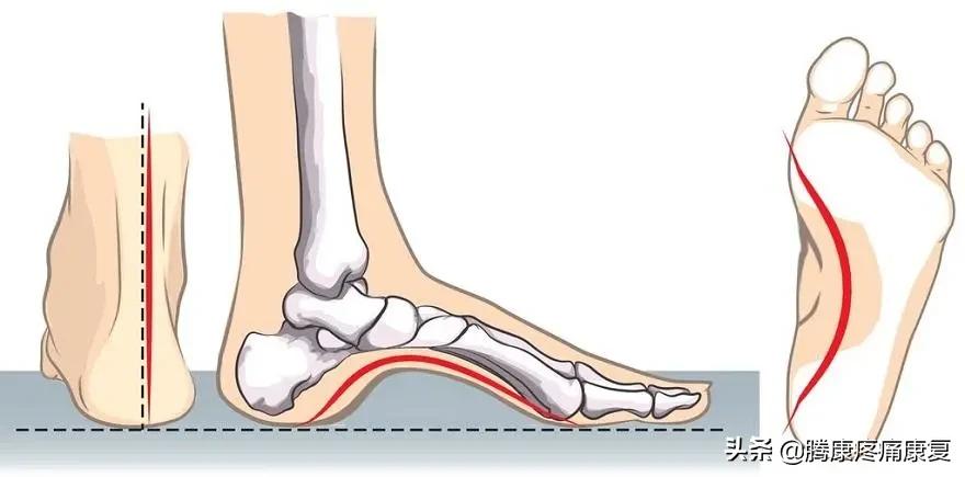 功能性高足弓的练习方式,足弓疼痛3个动作缓解