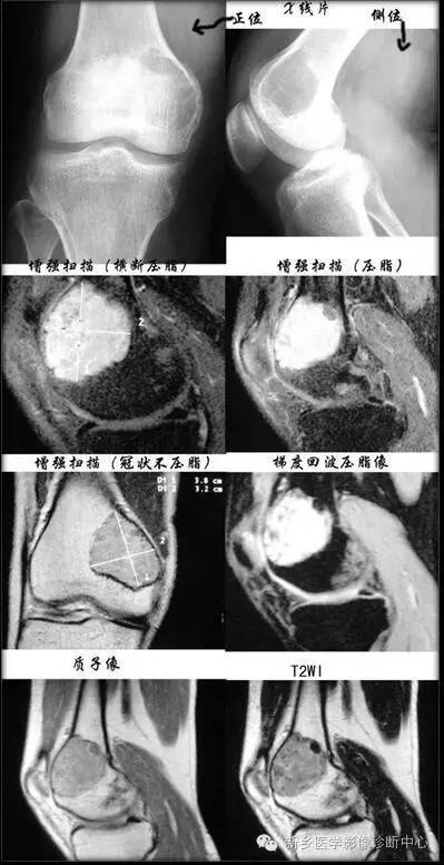 长骨膨胀性病变,长骨偏心性膨胀性病变