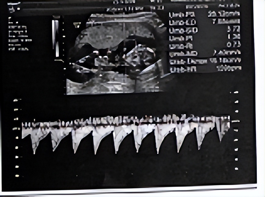 孕17+1周先兆流产！看37岁高龄孕妈如何用药保胎？