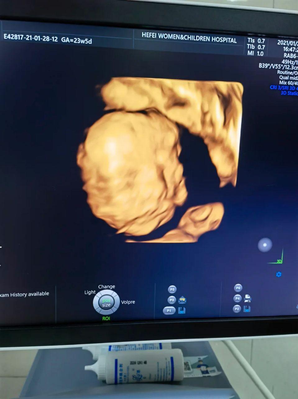 23周做了四维28周还需要再做吗,孕23周四维查出问题还能留吗