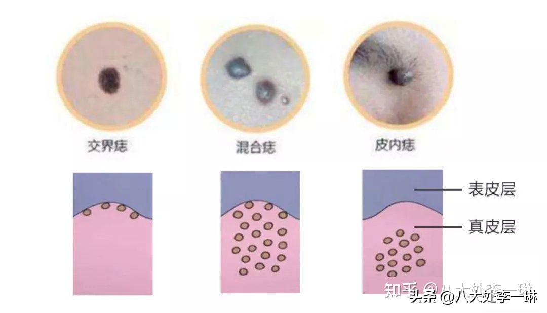 无色素痣怎么去除最好,什么是色素痣