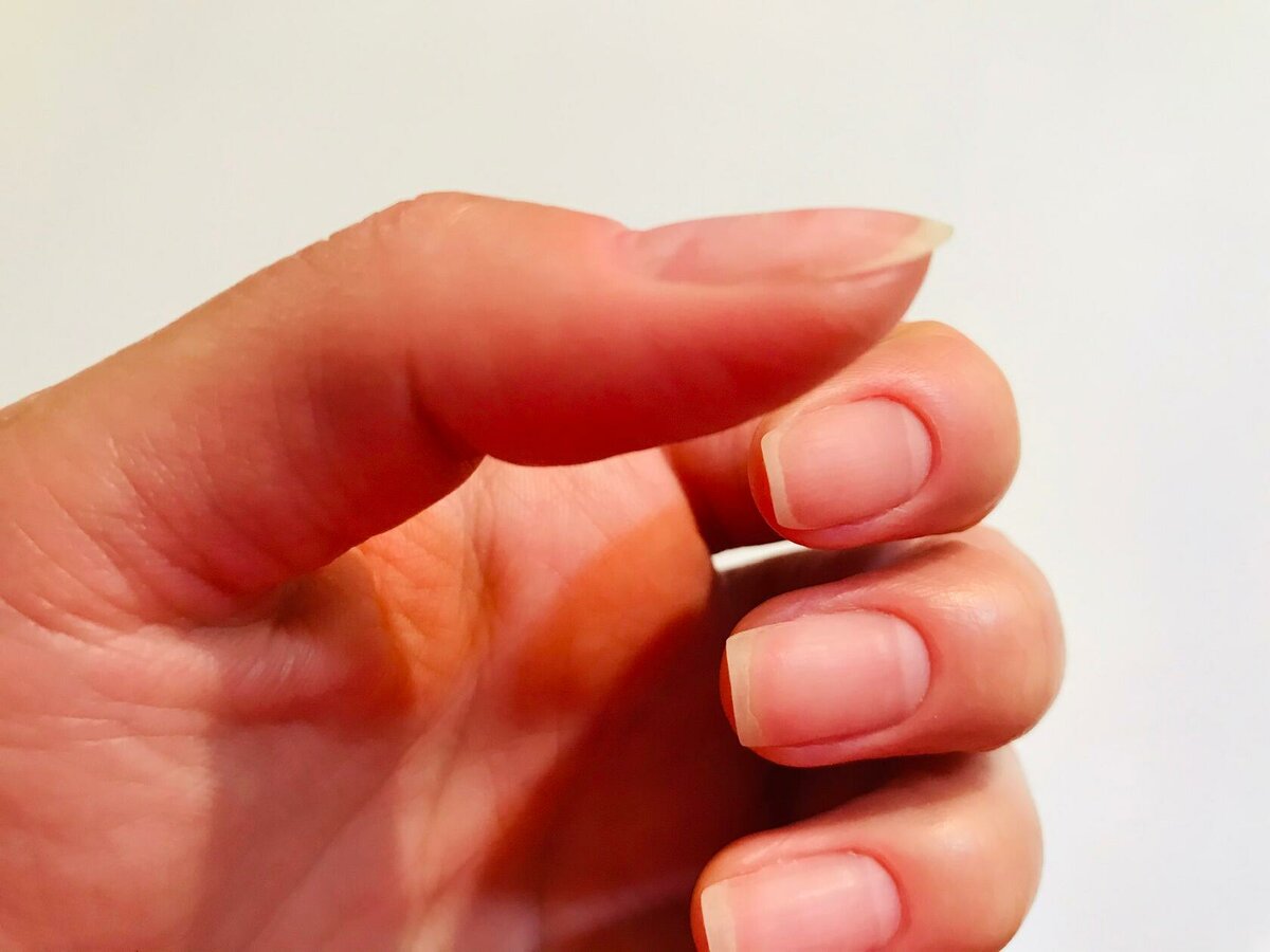 指甲渐变有条纹怎么解决,指甲薄有竖纹容易开裂不易长出来