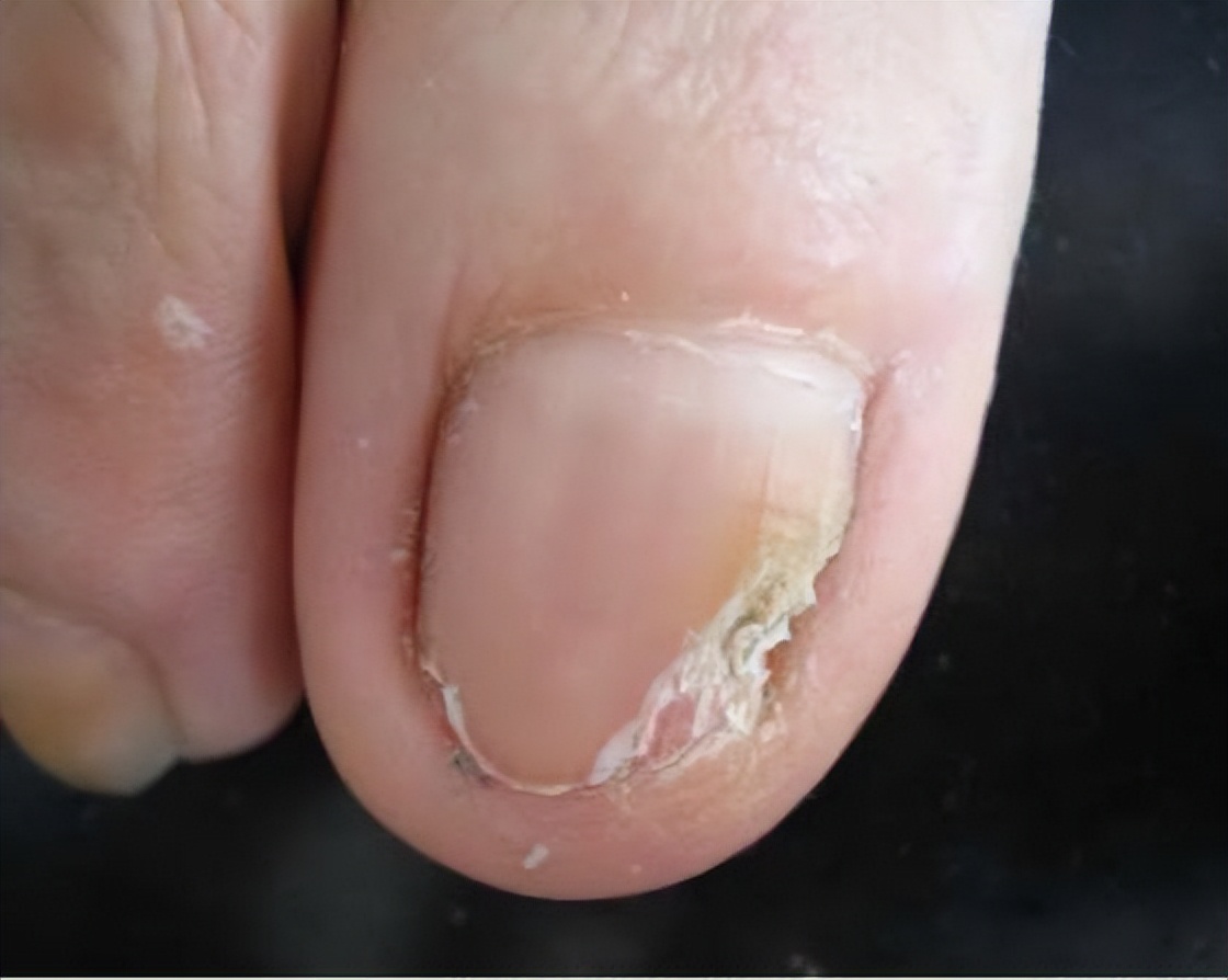 真菌性皮肤病—甲真菌病(灰指甲)