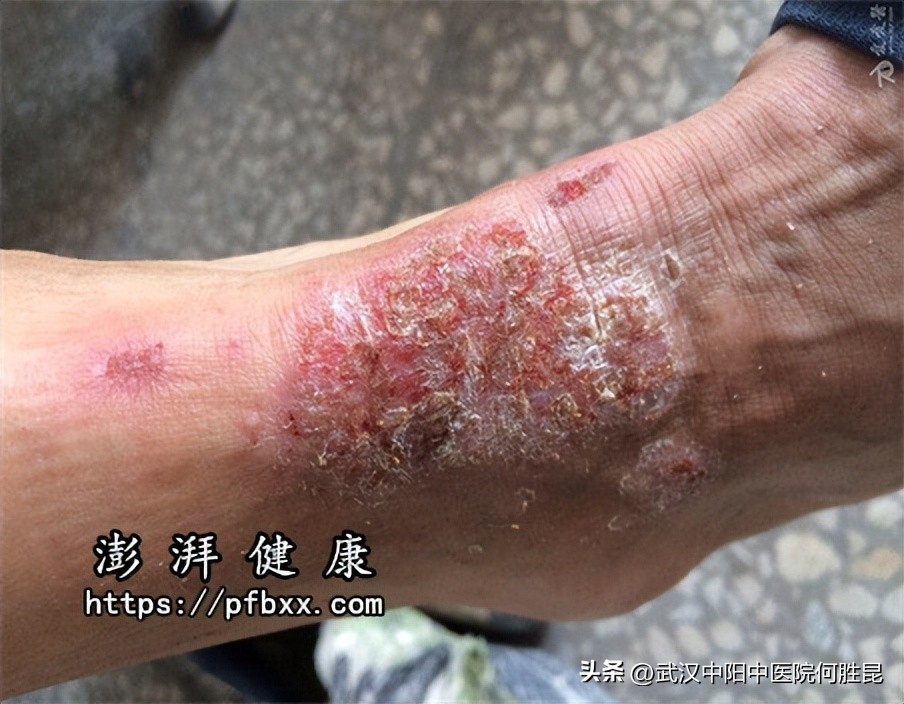 小腿上长了一片暗红癣脱皮痒,小腿上长癣很痒怎么治效果最好