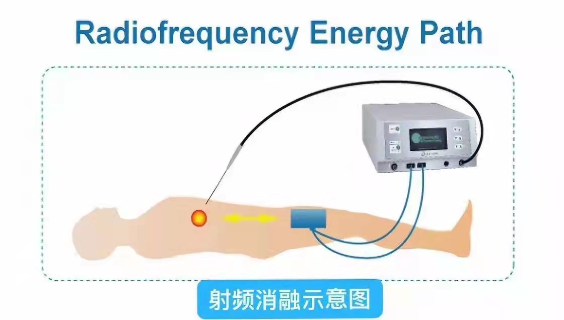 肠癌肝转移先做化疗还是介入,肠癌肝转移介入治疗哪里做得好