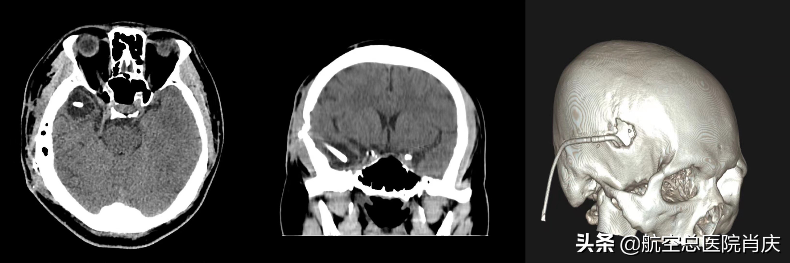 脑分流手术后头疼怎么回事,脑部分流手术后一直吐