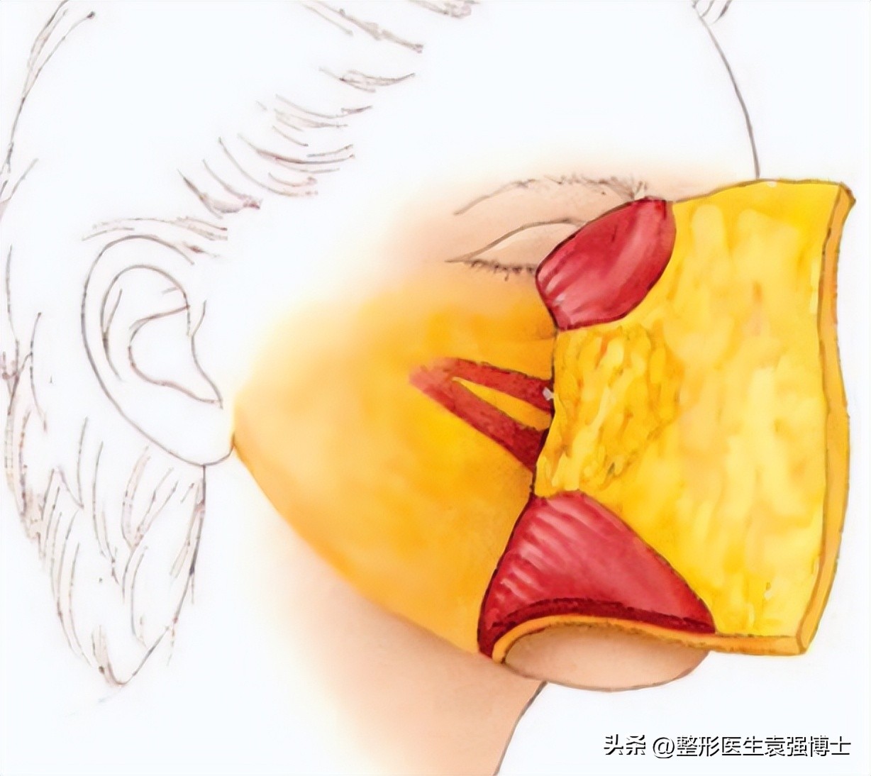 拉皮不剥离会留疤明显吗,拉皮手术如何防止留疤